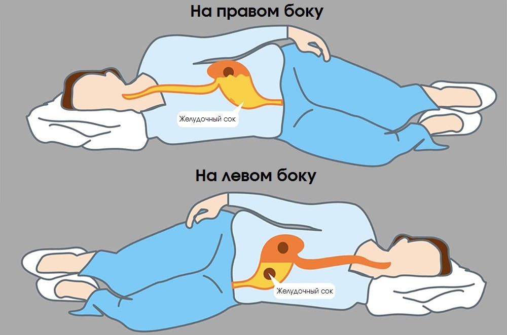 Желдочный сок стекает в пищевод при сне на правом боку, в отличии от сна на левом боку