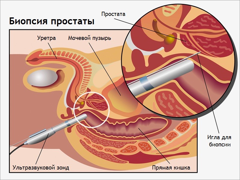 Как проводится биопсия предстательной железы