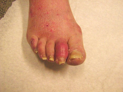 Фото ног при псориатическом артрите