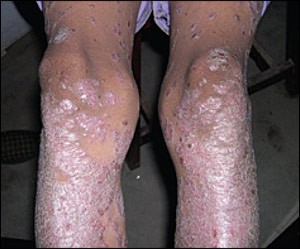 Фото ног при псориатическом артрите