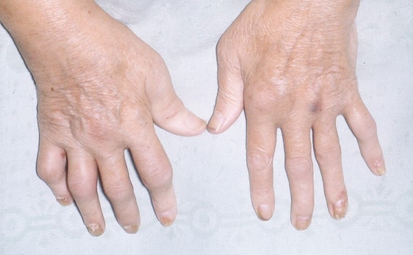 Фото рук при псориатическом артрите