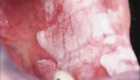 Фото лейкоплакии полости рта