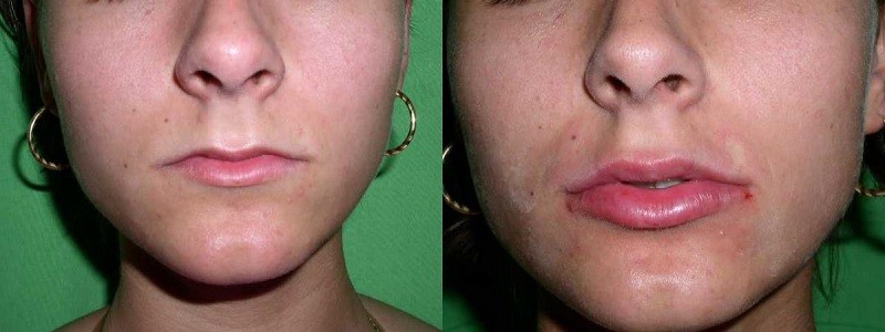 Увеличение губ с помощью хейлопластики. Фото до и после операции