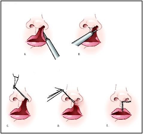 Как проходит процедура исправления "заячьей губы"