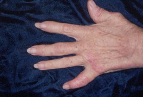 Фото рук при псориатической артропатии