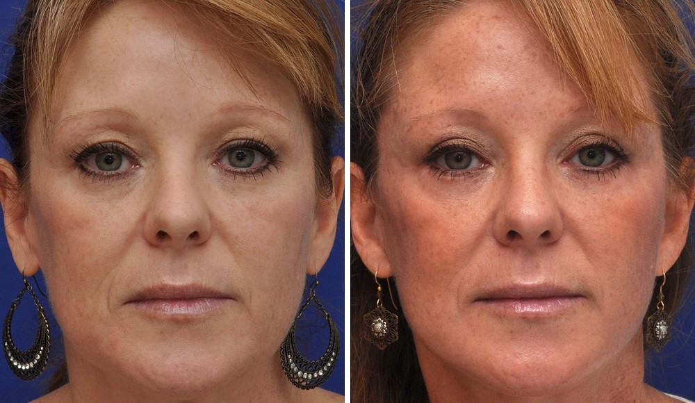 Блефаропластика до и после фото женщины 50 лет