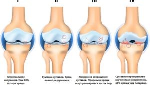 Стадии остеоартрита коленного сустава