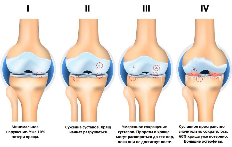 Стадии остеоартрита коленного сустава