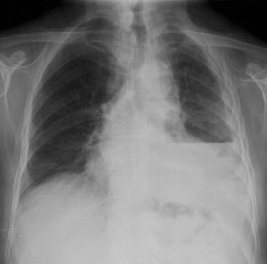 Гидроторакс на рентгенологическом снимке