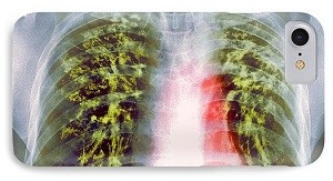 Фиброз легких в результате туберкулеза