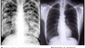 Ренгенологические снимки легких больного муковисцидозом и здоровых легких