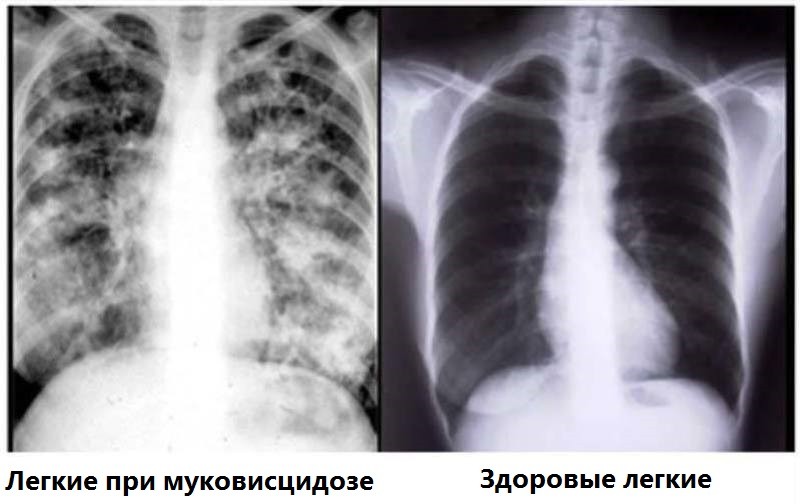 Ренгенологические снимки легких больного муковисцидозом и здоровых легких
