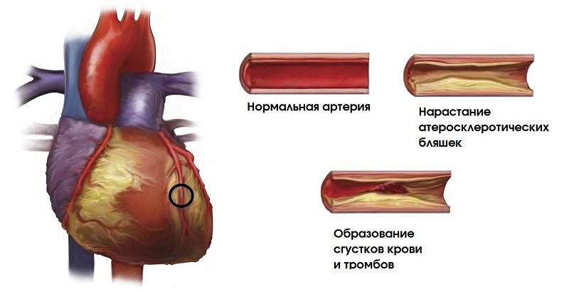Сердечно сосудистые заболевания атеросклероз. Атеросклероз коронарных артерий схема. Атеросклеротическое поражение коронарных артерий. Атеросклероз венечных артерий сердца. Нестенозирующий атеросклероз коронарных артерий.