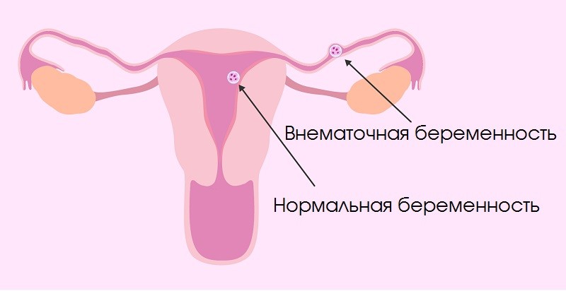 Нормальная и внематочная беременность