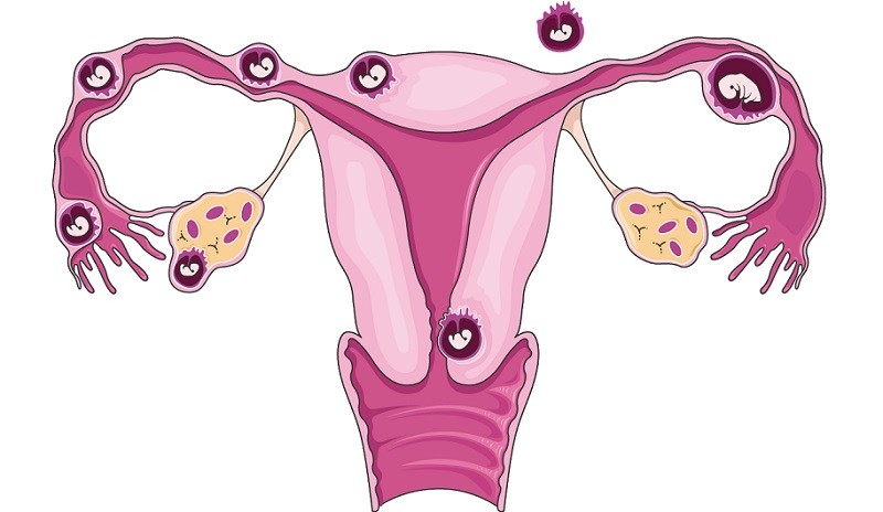 Возможные размещения эмбриона при внематочной беременности
