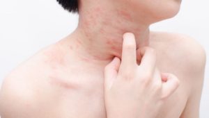 Аллергия на чеснок у ребенка