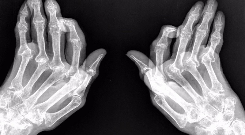 Рентген-снимок рук, пораженных ревматоидным артритом