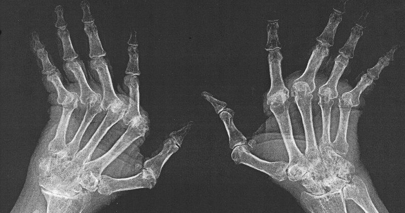 Рентген рук при ревматодном артрите