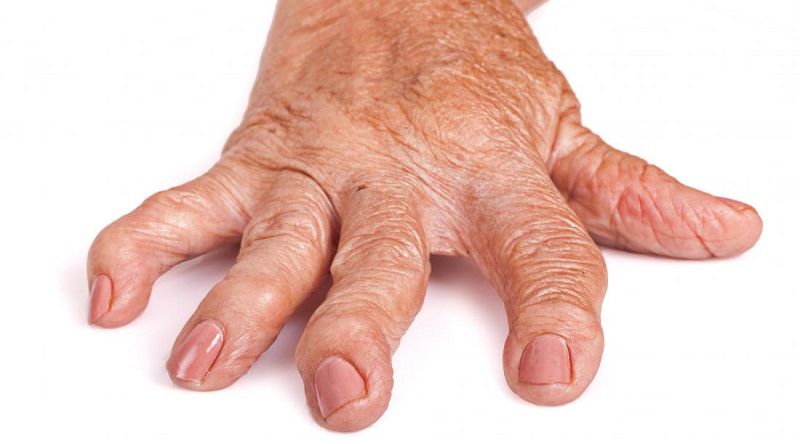 Ревматодный артрит рук