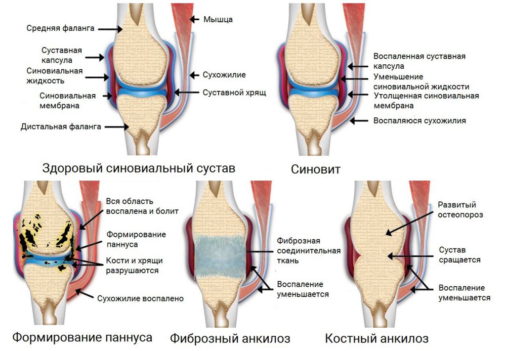 Что такое ревматоидный артрит, его стадии