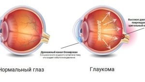 Что такое глаукома?