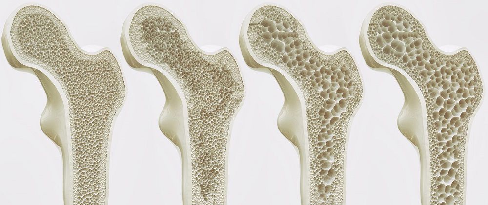 Степени остеопороза