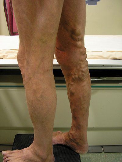 Варикоз на ногах (фото)