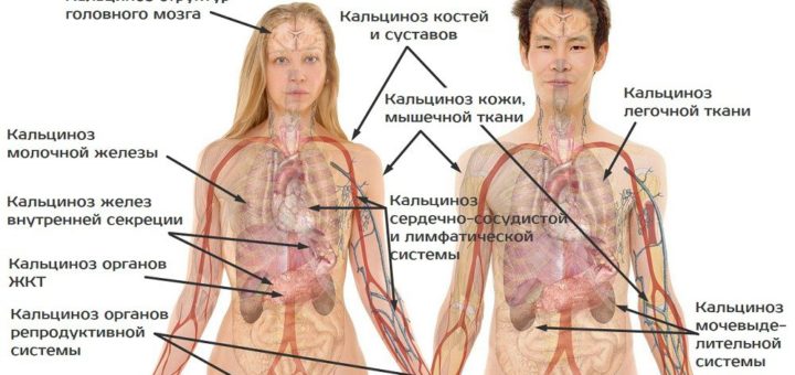Кальциноз – лечение, симптомы и причины, виды, диета, профилактика и ...