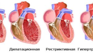 Виды кардиомиопатии