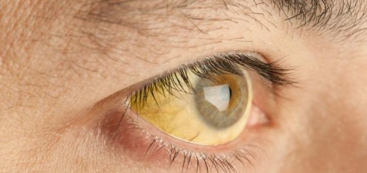 Синдром Жильбера – что это, симптомы, анализ, диагностика, лечение